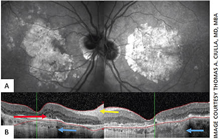 Figure 2. Outer retinal tubulation in neovascular AMD.