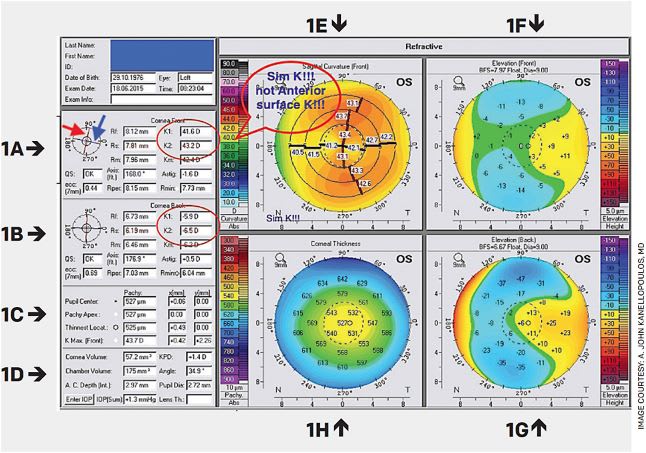 FIGURE 1. The four maps refractive report