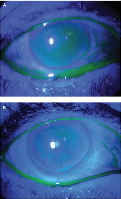 FIGURE 1. Note the prolonged retention of fluorescein long after instillation, due to delayed tear clearance and variability or feathering of the tear meniscus from canthus to punctum in these mechanical dry eye patients. (A) Restored uniformity of tear meniscus after preserved amniotic membrane use. (B).