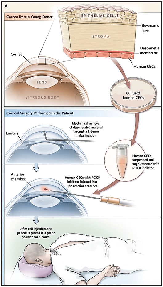 FIGURE 2. Panel A shows the schema of cell-injection therapy, in which CECs supplemented with a ROCK inhibitor are injected into the anterior chamber. After human CECs were removed from the Descemet’s membrane of a cornea obtained from a young deceased donor, isolated human CECs free of any contamination were cultured and subcultured. A few hours before cell injection, the cells were recovered, suspended to obtain the appropriate number and density, and supplemented with the ROCK inhibitor. After mechanical removal of the abnormal extracellular matrix on the patient’s Descemet’s membrane or the degenerated CECs (or both), the cultured human CECs supplemented with the ROCK inhibitor were injected into the anterior chamber of one eye of each participant. After the procedure, the patients were placed in a prone position for 3 hours.