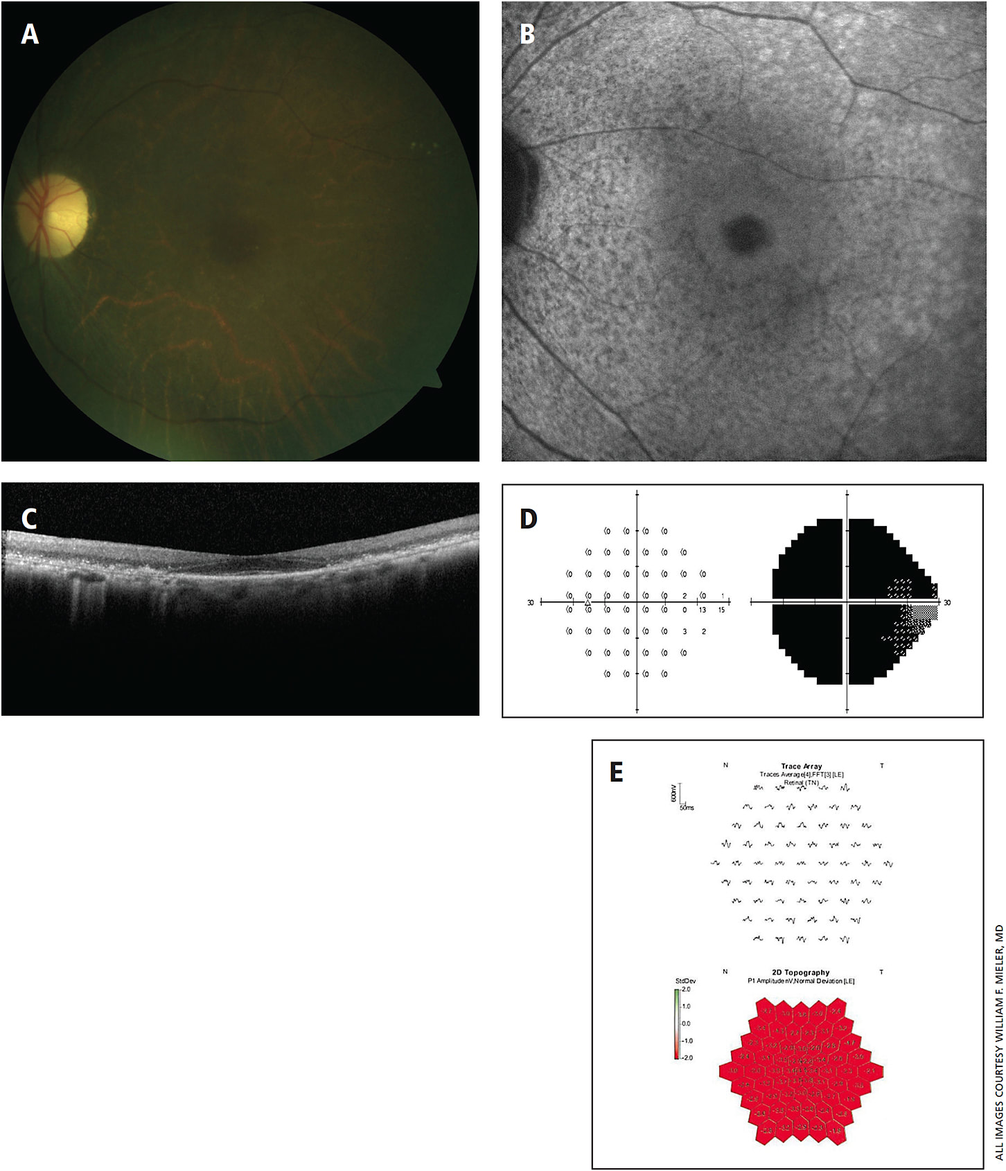 Figure 2. Severe hydroxychloroquine toxicity. A 66-year-old female referred for macular drusen. The patient had a long history of systemic lupus erythematosus and rheumatoid arthritis, which was managed with 31 years of hydroxychloroquine therapy at doses as high as 8.0 mg/kg/day despite worsening renal function. Her visual acuity was 20/30 at this time, but she complained of worsening peripheral vision. (A) Diffuse macular RPE atrophy. (B) Bull’s eye pattern of autofluorescence with mottled changes throughout the macula. (C) Diffuse outer retinal and RPE attenuation sparing the fovea. (D) Global depression on Humphrey visual field testing. (E) Multifocal ERG confirms the diagnosis of hydroxychloroquine toxicity with diffuse severe cone dysfunction.