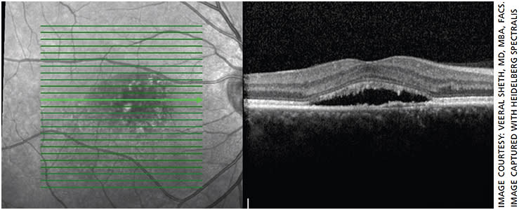 Figure 2. OCT of that patient on day of treatment showing cross-section of central retina.