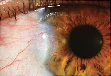 FIGURE 1A. Note the preoperative pterygium encroaching on the visual axis. IMAGE COURTESY ASHLEY BRISSETTE MD, MSC, FRCSC