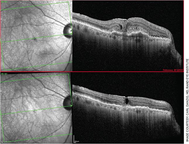 FIGURE 1. A 76-year-old female who complained of new-onset blurry vision for 3 weeks, presented with 20/200 vision in her right eye with CME, SRF, PED and subretinal hyperreflective material (top). She received Vabysmo in her right eye and, 1 month later, had remarkable anatomical improvement (bottom). However, her vision only improved to 20/100.