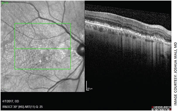 Figure 2. OCT OD showing a very small nasal to fovea pigment epithelial detachment with trace hyper-reflective sub-retinal material but no frank subretinal or intraretinal fluid. Image taken with Heidelberg SPECTRALIS.