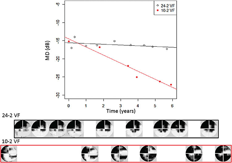 Figure 2: The progression of MD in the 10-2 VF and 24-2 VF in a given patient. In this patient, the rate of progression of MD over the first six 10-2 VFs was -2.3 dB/year, whereas over the first nine 24-2 VFs the MD rate was -0.14 dB/year.15