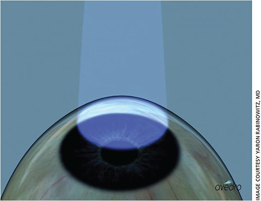 Uniform stromal riboflavin is visible after 15 minutes of loading in the epi-on procedure.