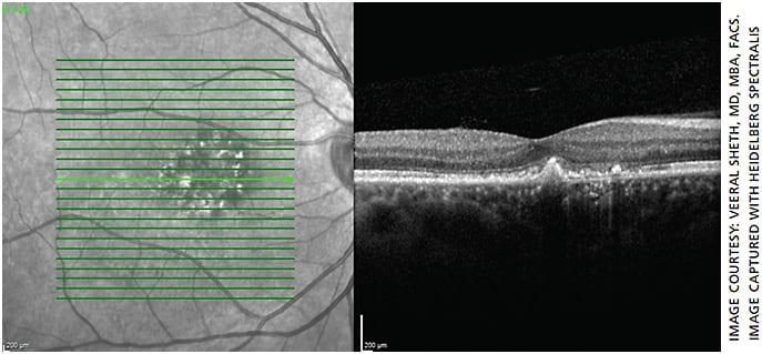 Figure 6. OCT of patient 6 weeks after treatment showing complete fluid resolution.