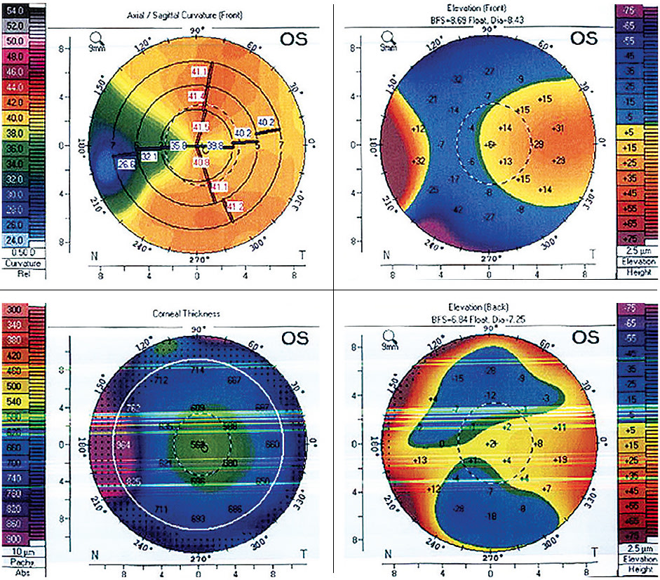 FIGURE 2. Note the preoperative topography of a patient with a nasal pterygium showing classic flattening and irregular astigmatism. IMAGE COURTESY ASHLEY BRISSETTE MD, MSC, FRCSC