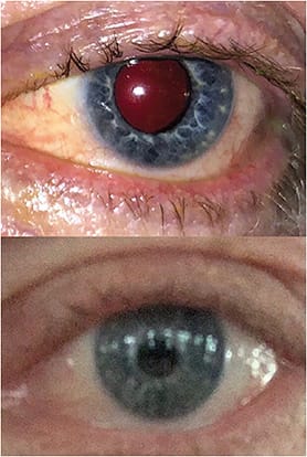 Figure 4. After IPL and thermal radiofrequency tissue tightening, the patient’s overall status improved significantly.