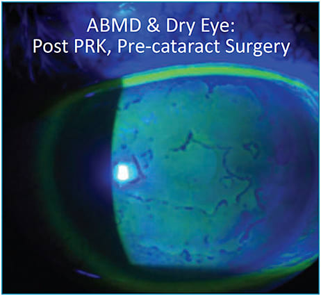 Figure 3. Before cataract surgery, this patient was treated with a Prokera biologic corneal bandage.