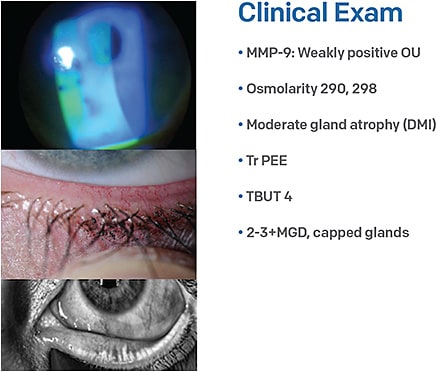 Figure 1. Patients who have moderate gland atrophy, such as this one, have lost at least half of their glands and should not expect one single therapy to resolve their disease.