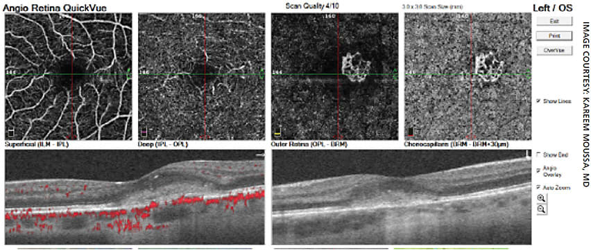 Figure 4. OCT-A reveals an abnormal network of vessels in the outer retina and choriocapillaris consistent with neovascularization.