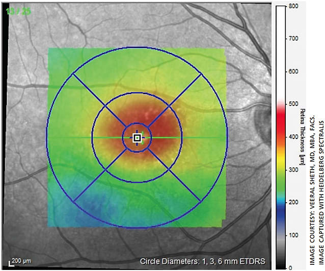 Figure 7. OCT of patient 6 weeks after treatment, showing complete fluid resolution.