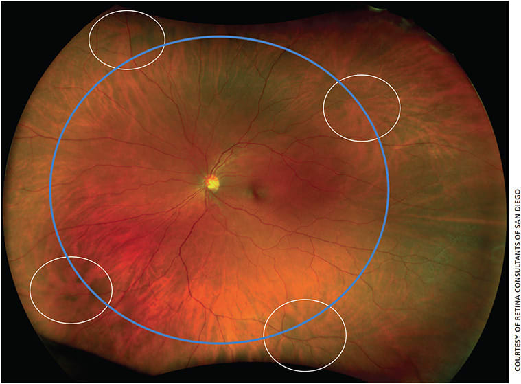 Figure 1. An ultra-widefield image, from the Optos California camera, shows a vortex ampulla marked in each quadrant.