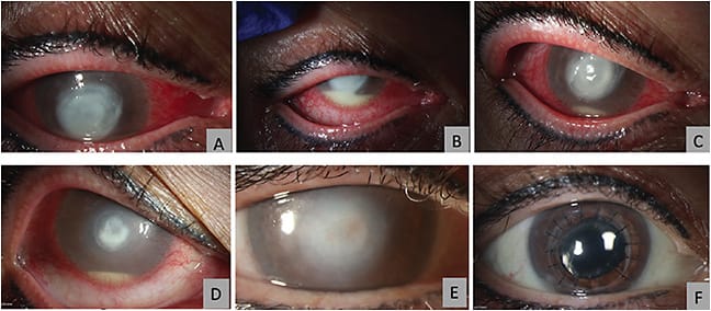 FIGURE 4. A 56-year-old female patient had a diagnosis of Acanthamoeba keratitis, by positive culture. (A and B) Her clinical appearance at presentation showed a deep central severe corneal infiltrate, with melting and thinning, and hypopyon. Rose bengal PDAT was performed, due to the patient not responding to standard medical treatment. (C and D) At 4 and 8 weeks after the procedure, the corneal melting and thinning stopped, her conjunctiva was more quiet, and her infiltrate and hypopyon were smaller. (E) At three months after Rose bengal PDAT, her corneal epithelium healed, and a corneal scar was left. (F) A corneal transplant was performed, and her cornea was clear 2 years after the cornea transplant.