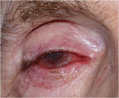 Figure 5: Cicatricial ectropion repair with tarsal strip and full-thickness skin graft from ipsilateral upper lid, permanent lateral tarsorrhaphy, and Gunderson flap used in case of refractor NK.