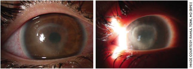 FIGURE 2. Slit lamp photographs of Acanthamoeba keratitis demonstrating ring infiltrate. The image to the right shows the disease a little further along.