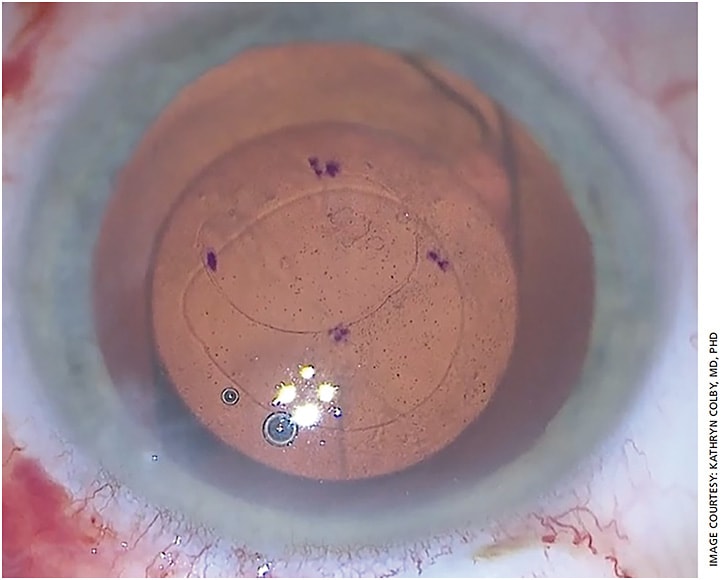 Surgeon view of a descemetorhexis performed following cataract extraction with posterior IOL placement. Note the cornea markings placed for proper sizing and centration and smooth edge of the descemetorhexis created using a round-tipped blunt DSO forceps (Moria).