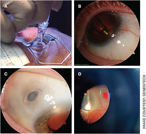 FIGURE. Patients from the ARCHWAY study: (A) PDS refill-exchange procedure; (B) PDS as seen through the anterior segment; (C) PDS implant on the scleral surface; and (D) The retro-illuminated PDS.