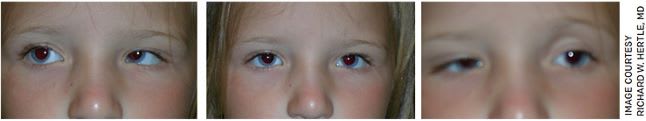 Figure 4. “Duane Syndrome” in patient’s left eye.