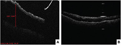 Figure 1. MiOCT (EnFocus) demonstrating subretinal fluid in the beginning of retinal detachment repair surgery (A). Confirmation of retinal re-attachment at the end of repair (B)