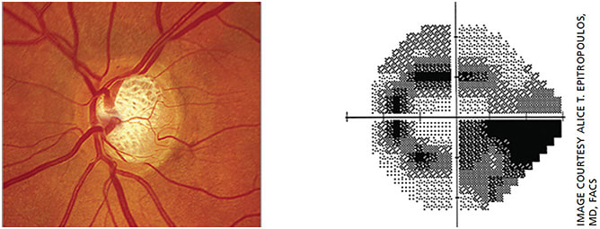 Figure 4. The 38-year-old female patient presented with moderate cupping of her optic nerves in both eyes and IOP in the low 20s.