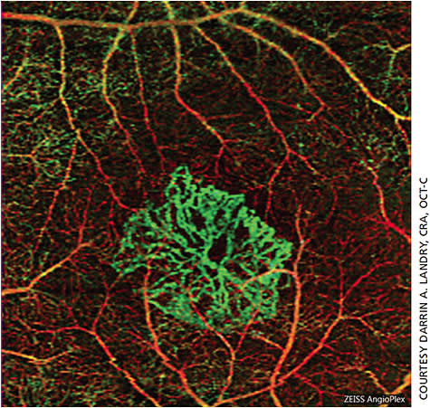 Figure 2. An example of choroidal neovascularization displayed via OCT angiography.