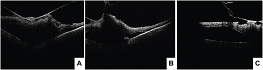 Figure 2. MiOCT (EnFocus) evaluation of tractional membranes in the beginning of tractional retinal detachment repair surgery (A). Real-time feedback during membrane peeling (B, C)