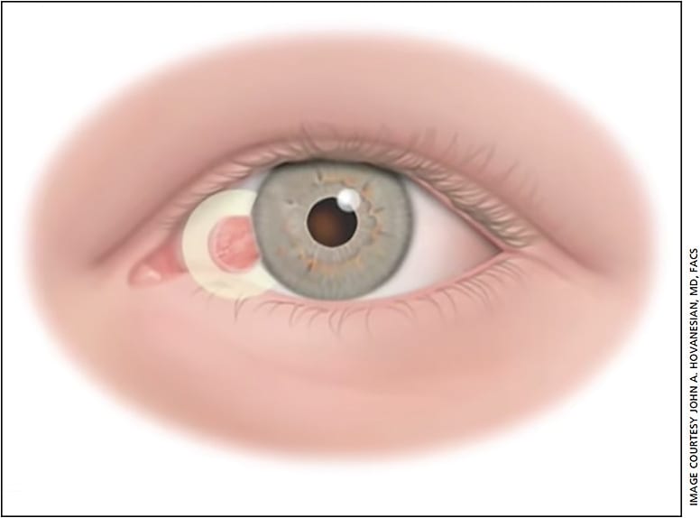 Figure 2. Conjunctival autograft combined with subconjunctival amniotic membrane graft is reserved for high-risk cases, which include larger or inflamed pterygium or pterygium that are more likely to recur, especially those that have been previously excised.