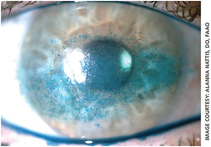 Figure 3. Slit lamp photo showing severe ocular surface disease with central lissamine green staining.