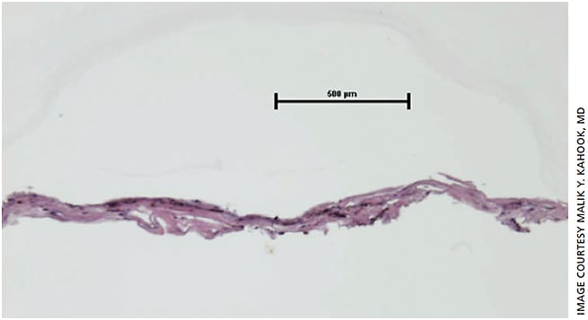 Figure 3. A histologically prepared strip of TM removed using KDB.