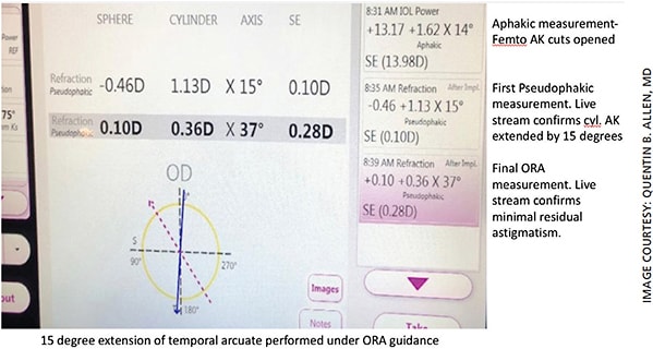 Figure 2. Initial pseudophakic measurement and final IA measurement demonstrating residual astigmatism of 0.36 D.