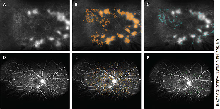 FIGURE 1. Representative quantitative ultra-widefield angiographic images (A and D) with segmentation overlay general and perivascular leakage (B and C, respectively), microaneurysms (E), and ischemia (F).