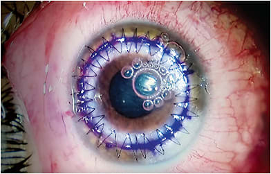 FIGURE 1. A completed DALK using the big-bubble technique: Anterior chamber bubbles are sometimes seen as the air can transect into the periphery, and migrate into the AC, presumably via the Schlemm’s canal and trabecular meshwork. IMAGE COURTESY NEDA SHAMIE, MD