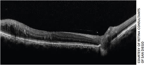 Figure 3. This OCT image looks normal, even though UWF images showed the patient had significant peripheral lesions.