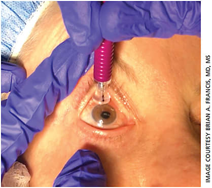 Figure 3. Surgical photograph of the probe placement for treatment of the superior hemifield in MicroPulse CPC (cyclophotocoagulation).