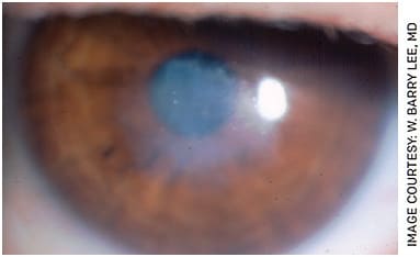 FIGURE 2. Slit lamp photo showing marked anterior stromal scarring after epi-off crosslinking in India.