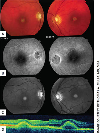 Figure 8. Adult-onset foveomacular vitelliform dystrophy.