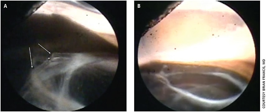 Figure 3. A) Endoscopic surgical image of a patient with uveitis-glaucoma-hyphema syndrome; the sulcus haptic of a one-piece acrylic IOL had been removed but there was still iris trauma from the anteriorly directed cut edge of the optic. The arrows show the extent of the cut edge responsible for the continued iris trauma. B) View of the anterior capsule, showing the lens has been completely reposited into the surgically reopened capsular bag.