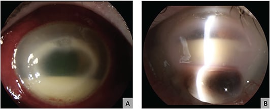 FIGURE 1. A 60-year-old female patient had a diagnosis of Acanthamoeba keratitis, by positive culture. (A) Her clinical appearance at presentation showed a deep corneal infiltrate, with superior thinning, and hypopyon. The patient did not respond to standard medical treatment. (B) At 8 weeks after treatment, her cornea started to melt, and inferior descemetocele with perforation developed.