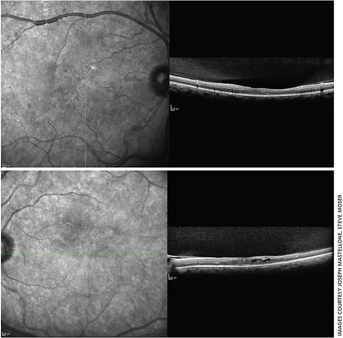 Figures 3a and 3b. Optical coherence tomography of the macula OU demonstrating severe retinal thinning from macular ischemia OU and macular edema OS.