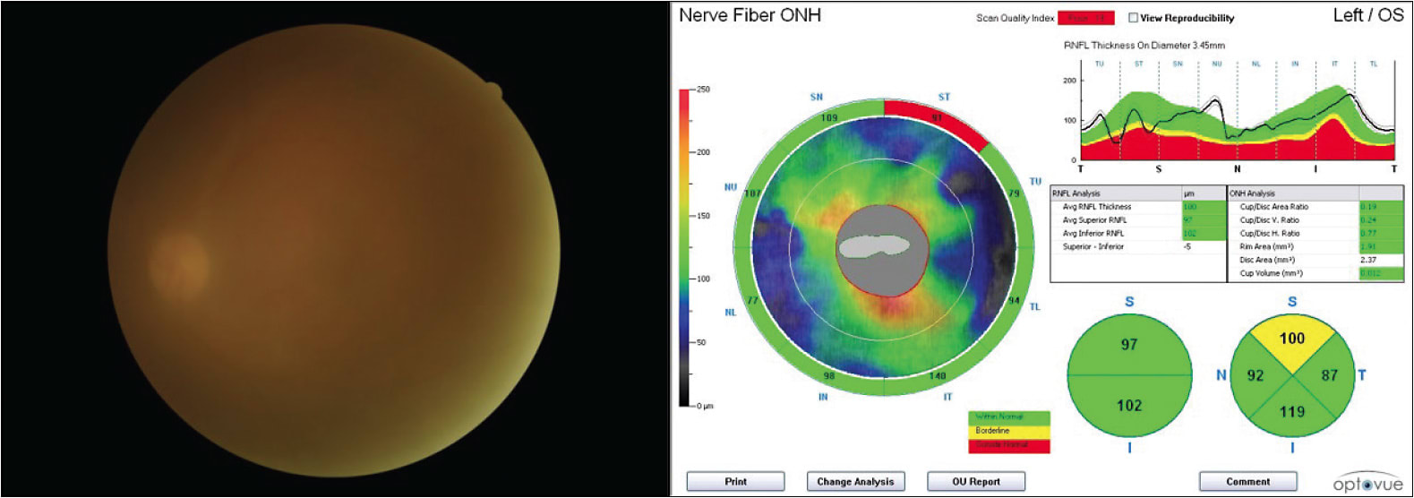 Figure 1. Using tele-glaucoma, OCT can acquire data even when digital imaging is hindered by media opacity.