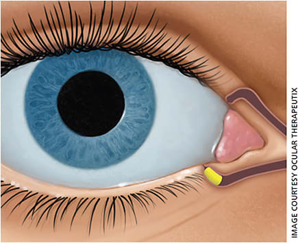 Figure 2. The Dextenza ophthalmic insert is a 0.4-mm dissolvable intracanalicular plug that delivers a taper of steroids over a month.