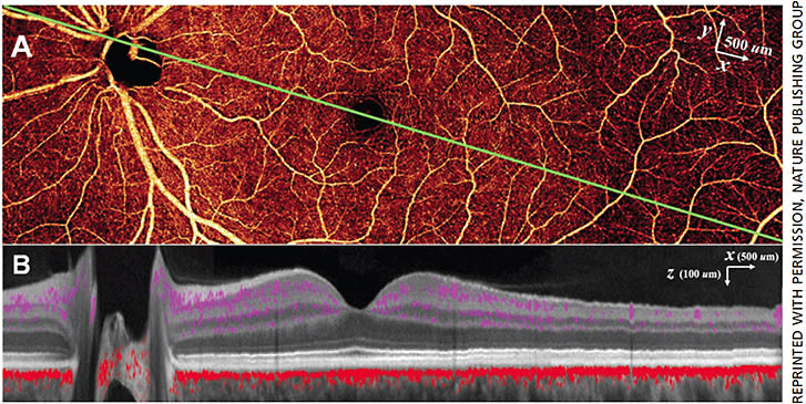 Figure 2. PR-OCTA in the left eye of a normal study participant. Four 4.5 mm × 4.5 mm OCTA volumes were montaged. (A) 14.2 mm × 4.5 mm en face OCTA of the inner retina. The cross-sectional image (B) is taken along the maculopapillary axis (green line joining the centers of the fovea and optic disc). (B) Color-composite cross-sectional OCTA (14.2 mm × 0.7 mm) showing retinal (purple) and choroidal (red) blood flow superimposed on gray scale reflectance image of static structures.7