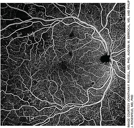 Figure 5. 12mm x 12mm widefield swept-source OCT angiography image of an eye with non-proliferative diabetic retinopathy. Image obtained via Zeiss PLEX Elite 9000.