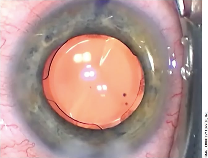 Figure 2: The ClearView 3 IOL is appropriate for presbyopic adults with less than 1 D of astigmatism.