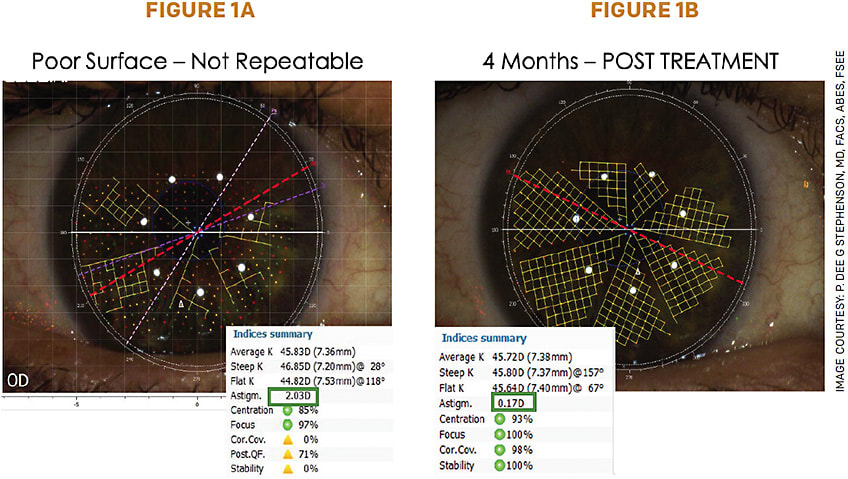 FIGURE 1. Cassini surface qualifier honeycomb pattern using a Cassini topographer. A: The cornea before treatment having 2 D of astigmatism. B: Results after 4 months of treatment.