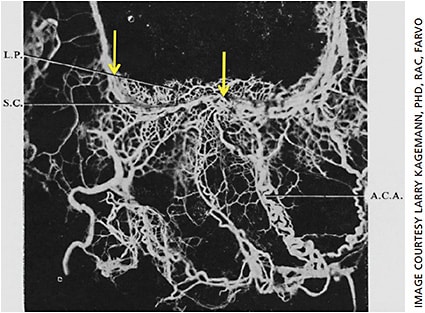 Figure 2. Despite distortions associated with the high pressures required to push neoprene through the outflow vasculature, Dr. Ashton’s castings revealed the splitting of Schlemm’s canal into multiple parallel pathways, which converged again into a single pathway.