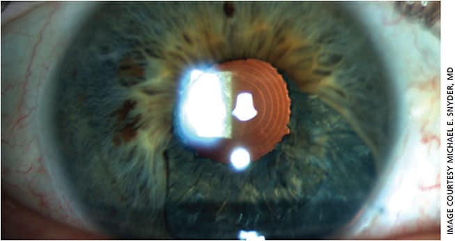 Figure 2. In-the-bag custom, flexible iris, post-iridocyclectomy.